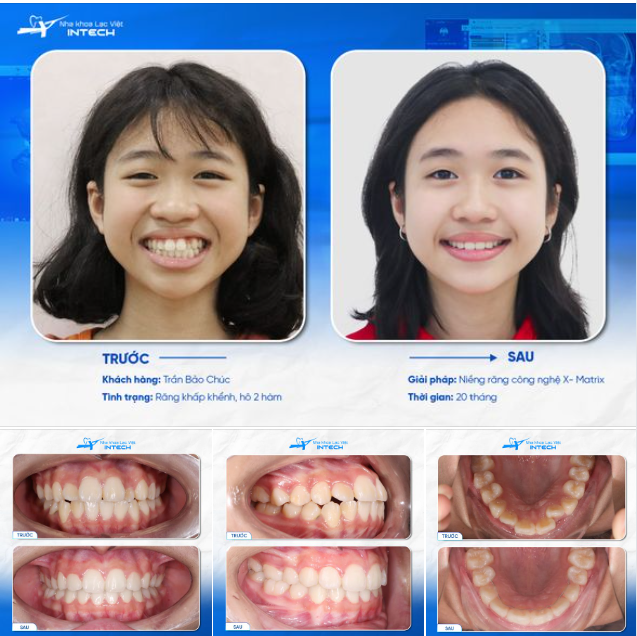 SỢ CON “KHÔNG CÓ TUỔI THƠ” VÌ RĂNG XẤU, PHỤ HUYNH GỬI GẮM NỤ CƯỜI CỦA CON CHO LẠC VIỆT INTECH!