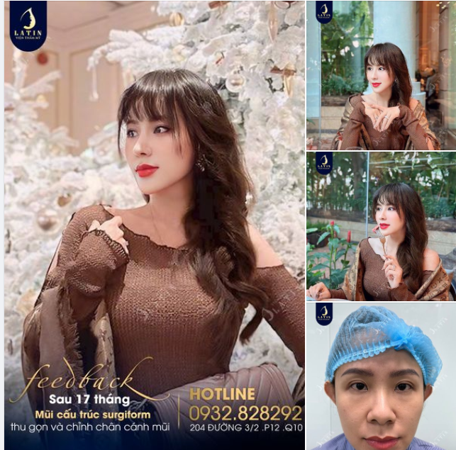2 năm nhìn lại... Gần 2 năm sau nâng mũi, cuộc sống của chị đã thay đổi hơn rất nhiều.