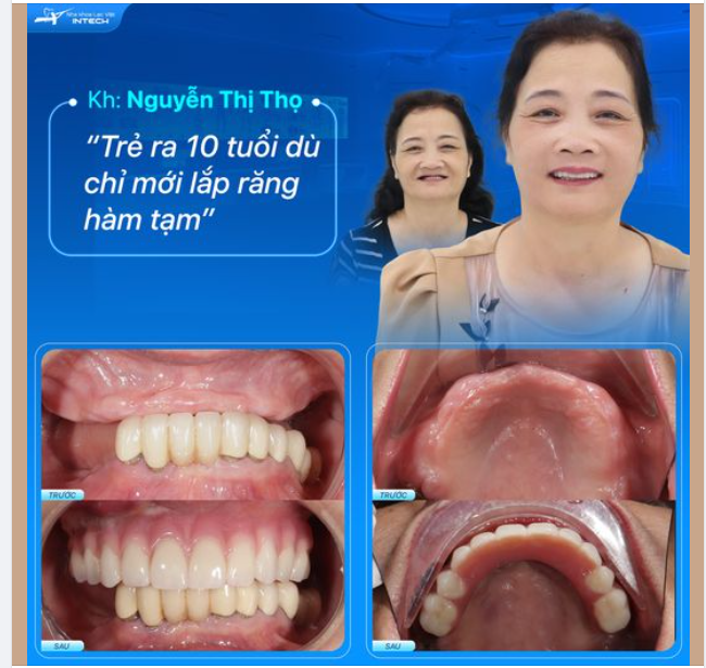 TRẺ RA 10 TUỔI NGAY SAU KHI PHẪU THUẬT TRỒNG RĂNG TOÀN HÀM