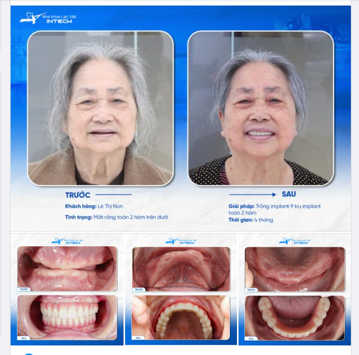 TRỒNG RĂNG TOÀN 2 HÀM ĐỂ ĂN NHAI TỐT AN VUI TUỔI GIÀ