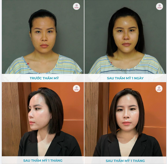 MẶT CÂN ĐỐI, MỀM MẠI TỰ NHIÊN SAU THẨM MỸ