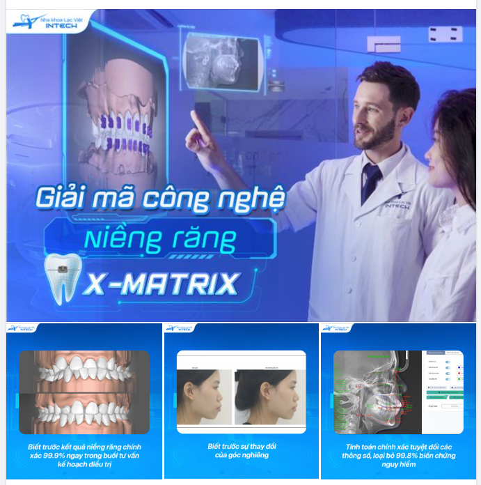 VÌ SAO X-MATRIX LÀ CÔNG NGHỆ NIỀNG RĂNG ĐƯỢC KHÁCH HÀNG TIN TƯỞNG NHẤT HIỆN NAY?