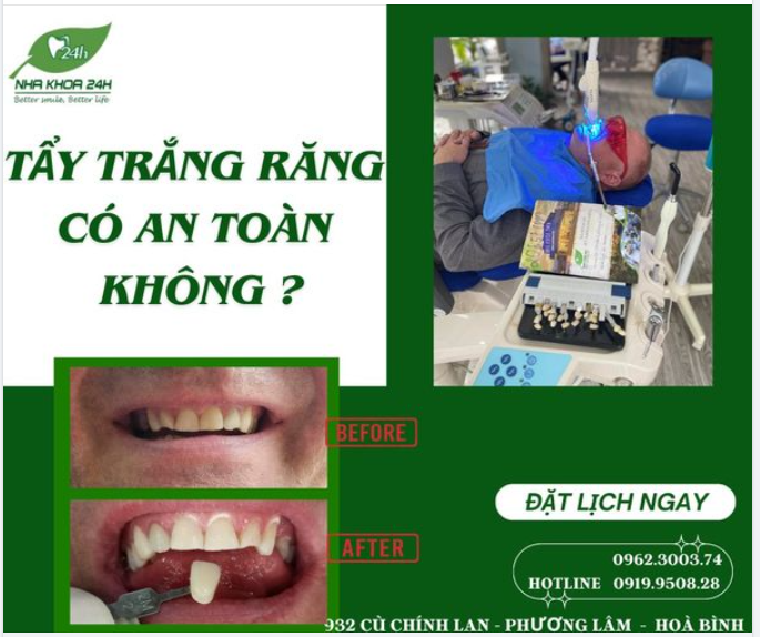 TẨY TRẮNG RĂNG CÓ AN TOÀN KHÔNG? 