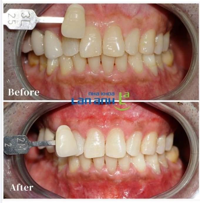 Tẩy trắng răng là phương pháp giúp cải thiện vẻ đẹp của hàm răng một cách hiệu quả, khiến bạn tự tin hơn trong giao tiếp.