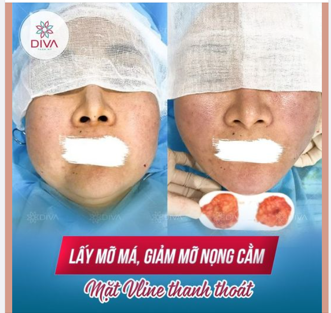 KẾT QUẢ THẨM MỸ SAU LẤY MỠ MÁ, GIẢM MỠ NỌNG CẰM - GƯƠNG MẶT NHẸ NHÀNG, THON GỌN