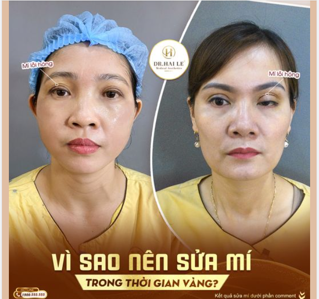 VÌ SAO NÊN SỬA MÍ TRONG THỜI GIAN VÀNG