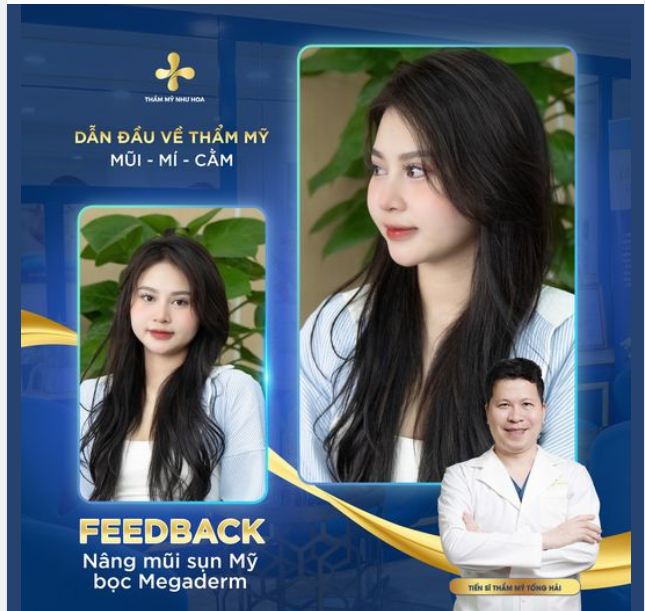 Mũi đẹp tự nhiên một năm tuổi của bạn Thu Thảo đến từ Nam Định.