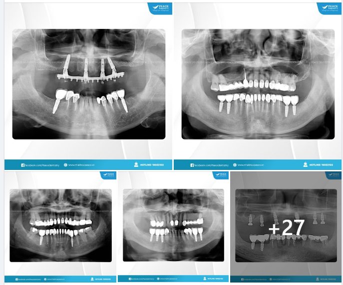 IMPLANT GALLERY 04-2024 | PEACE DENTISTRY