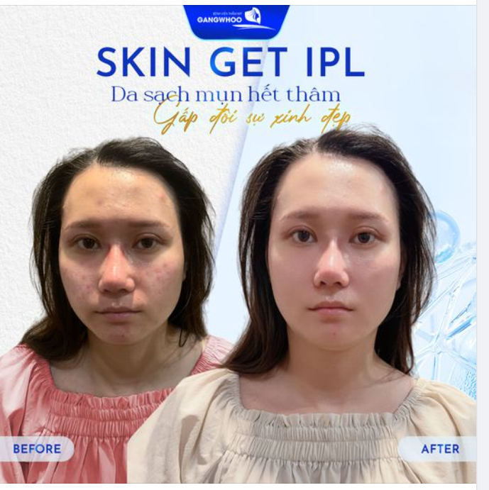 CÔNG NGHỆ SKIN GET IPL