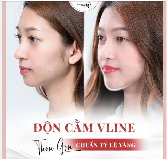 Nếu bạn đã quá Mệt Mỏi với việc tiêm dặm Filer thường xuyên mà kết quả lại không như mong muốn, mất thời gian sưng bầm tím thì hãy thử ngay phương pháp độn cằm Vline tại VTMHN