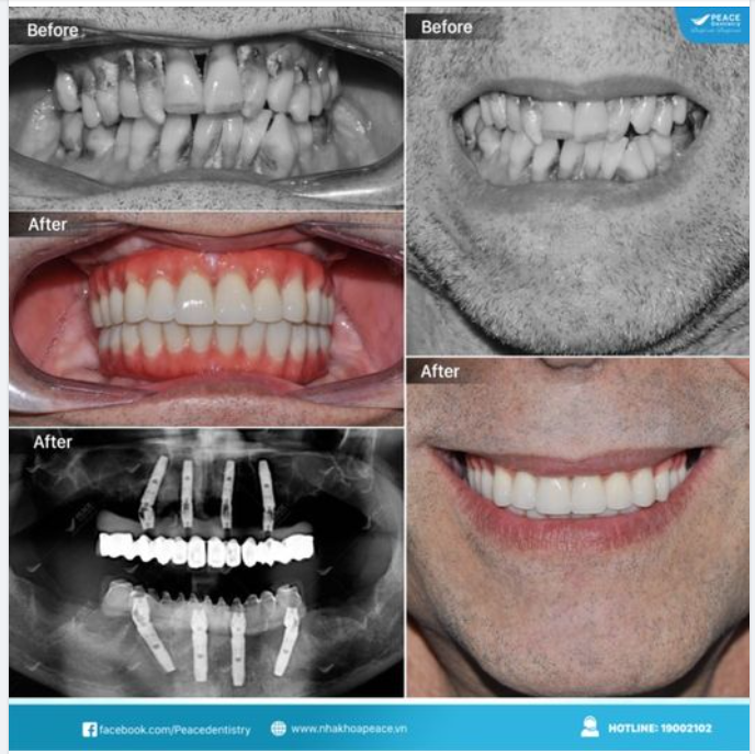 VỚI 2 - 3 TUẦN TẠI VIỆT NAM, CÓ ĐỦ THỜI GIAN ĐỂ HOÀN THÀNH MỘT CA ALL-ON-X IMPLANT?