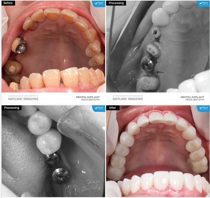Ca lâm sàng implant kết hợp làm răng sứ thẩm mỹ cho cô khách hàng Việt Kiều