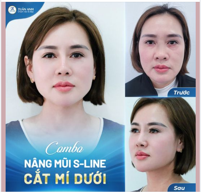 KH U40 tự tin tỏa sáng sau khi thực hiện combo nâng mũi - cắt mí