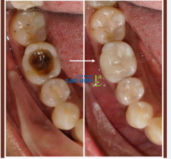 Vì sao Inlay sứ lại có nhiều ưu điểm hơn so với trám răng thông thường, đặc biệt là ở những răng bị sâu lớn?