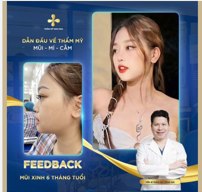 Feedback dáng mũi 6 tháng của girl xinh 2005