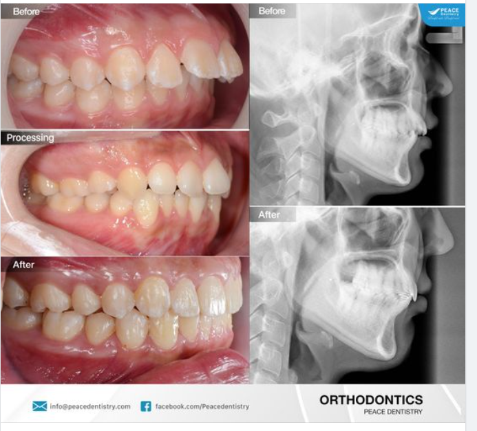 Ca lâm sàng invisalign chỉnh hô & hiệu quả sau 18 tháng điều trị.