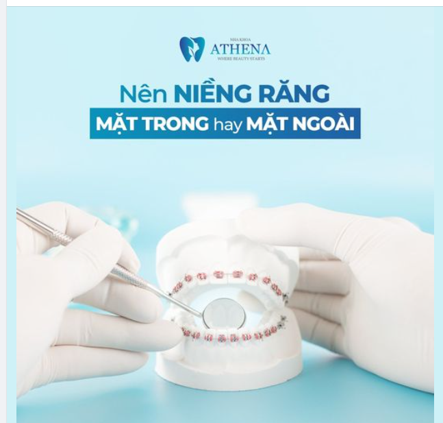 NÊN LỰA CHỌN NIỀNG RĂNG MẶT TRONG HAY NIỀNG RĂNG MẶT NGOÀI