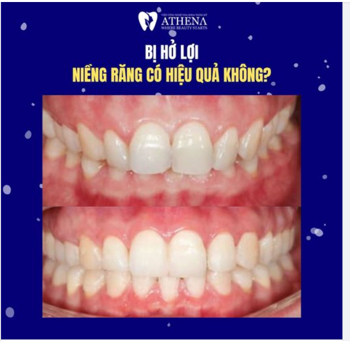 Bị Hở Lợi, Có Nên Niềng Răng?
