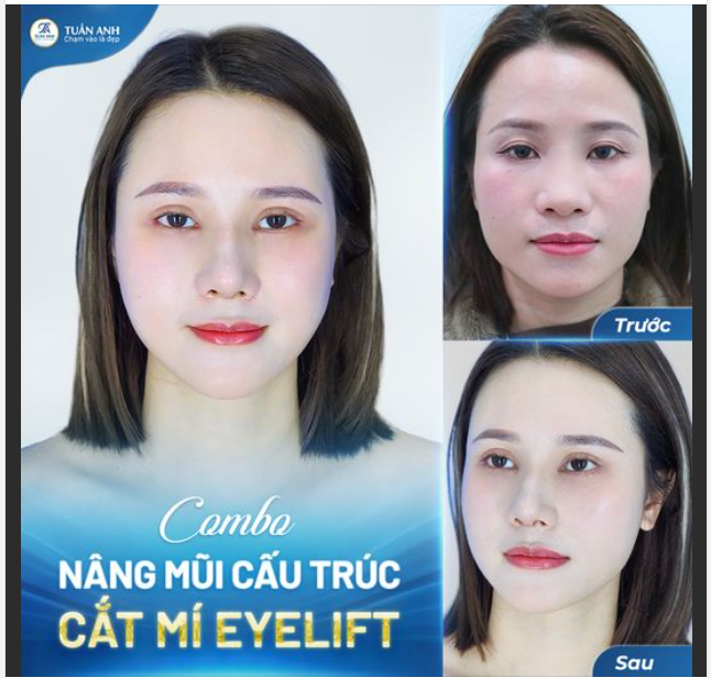 Combo nâng mũi cắt mí sẽ khiến bạn thay đổi như thế nào?