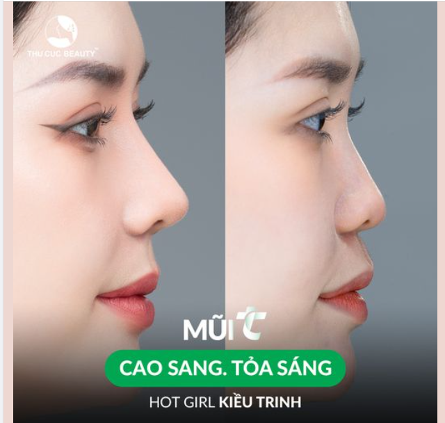 Xóa sổ sống mũi thấp cùng Mũi TC