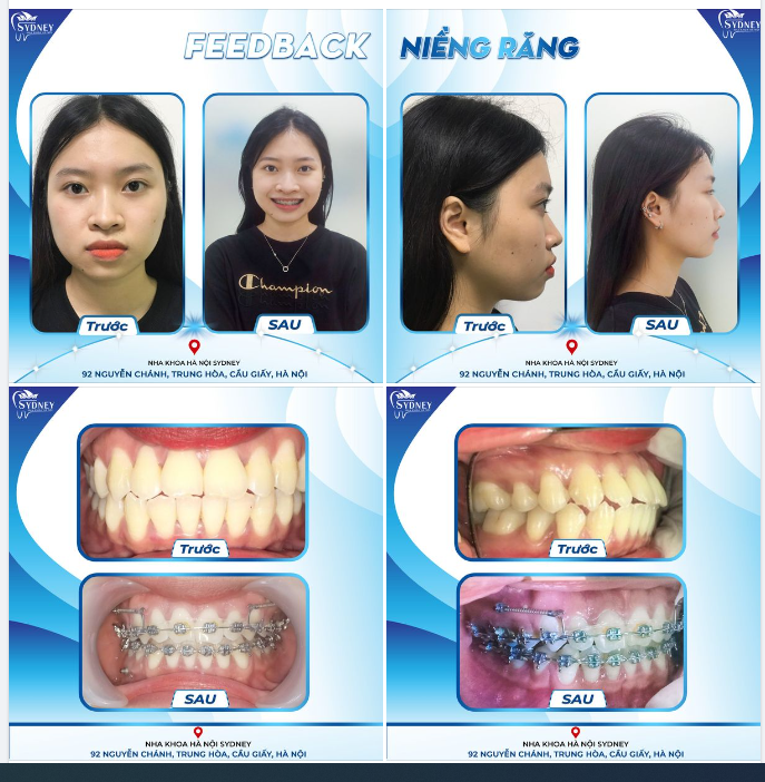 NIỀNG RĂNG CHO NỤ CƯỜI HẠNH PHÚC