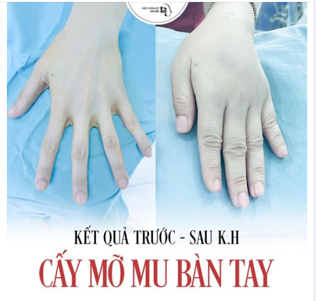 CẤY MỠ MU BÀN TAY - GIẢI PHÁP TỐI ƯU CHO ĐÔI TAY ĐẸP TỰ NHIÊN