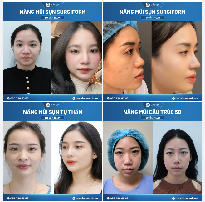 Cập nhật hình ảnh khách hàng sở hữu dáng mũi tự nhiên, hài hòa tại Thẩm mỹ Tuấn Anh
