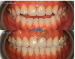 Niềng răng Invisalign mới có gần 1 năm, mà thay đổi rất nhiều!