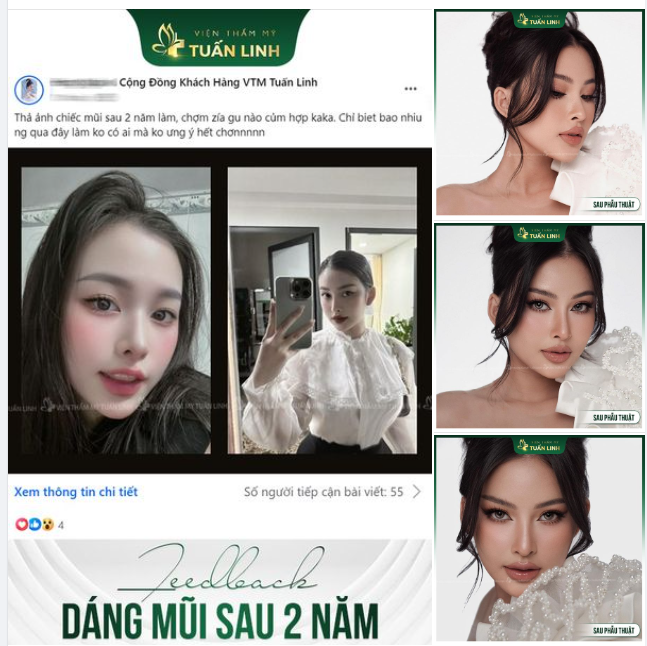 Phong thủy tốt, tài lộc phất lên như "diều gặp gió" sau 2 năm nâng mũi!!