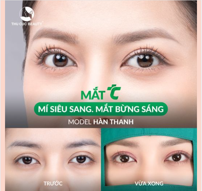 Mắt TC -30% duy nhất 10 suất làm đẹp hôm nay