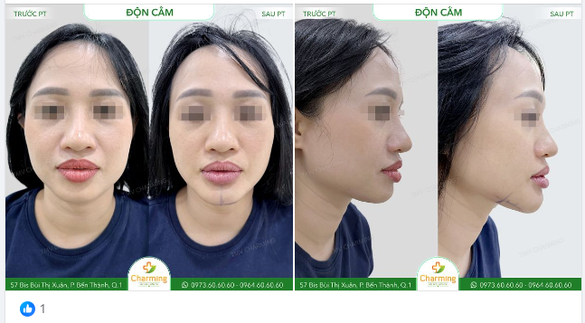 Nếu bạn cũng đang gặp phải vấn đề cằm thiếu độ dài, độ nhô khiến cho gương mặt trông như bị hô và mất cân đối như nàng khách của Charming đây thì độn cằm chính là giải pháp dành cho mọi người.