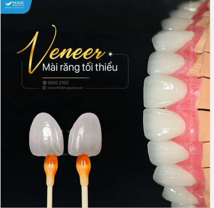MẶT DÁN SỨ VENEER | XÂM LẤN TỐI THIỂU /English below/