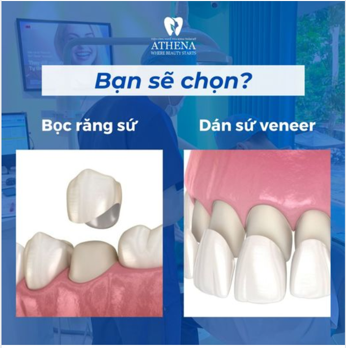 Sự Lựa Chọn Giữa Dán Sứ và Bọc Sứ Thẩm Mỹ