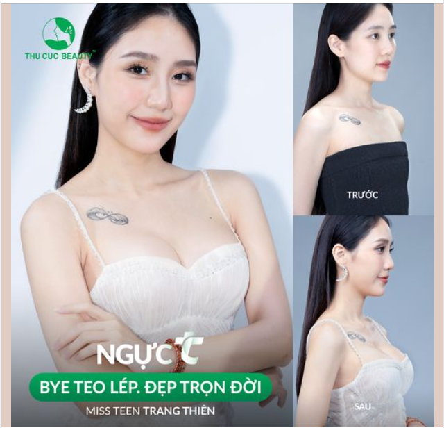 Tái tạo V1 teo lép chỉ sau 60P cùng Ngực TC