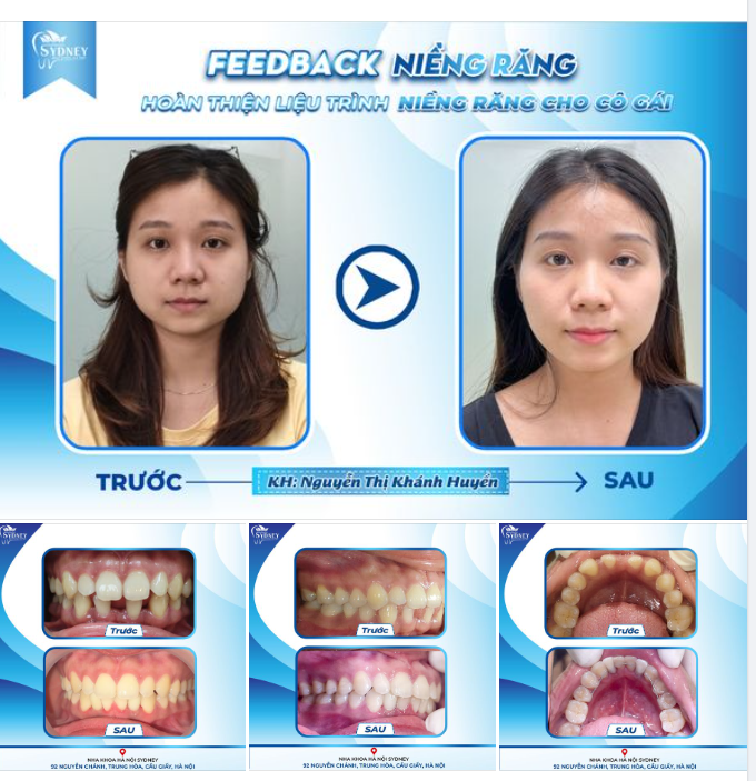 HOÀN THIỆN LIỆU TRÌNH NIỀNG RĂNG CHO CÔ BẠN KHÁNH HUYỀN