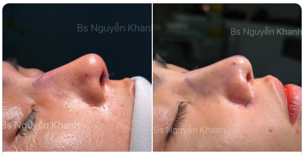 Sau tất cả đích đến cuối cùng của chúng ta vẫn là "MỘT CHIẾC MŨI ĐẸP" thì nâng LÓT SỤN hay CẤU TRÚC đều cũng ra chiếc mũi đẹp khi qua bàn tay của BS Khanh.