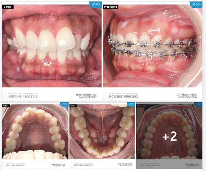 Ca lâm sàng chỉnh nha không nhổ răng cho trường hợp răng chen chúc & hiệu quả sau gần 1.5 năm đ.iều trị