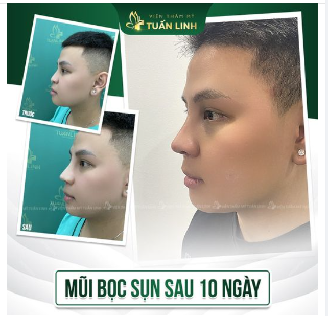 MŨI BỌC SỤN SLINE CAO SAU 10 NGÀY!!