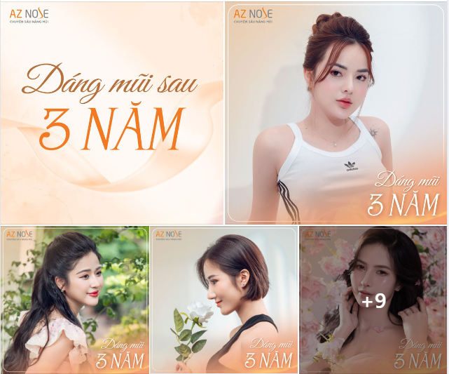 Dáng mũi sau 3năm của khách hàng AZ NOSE