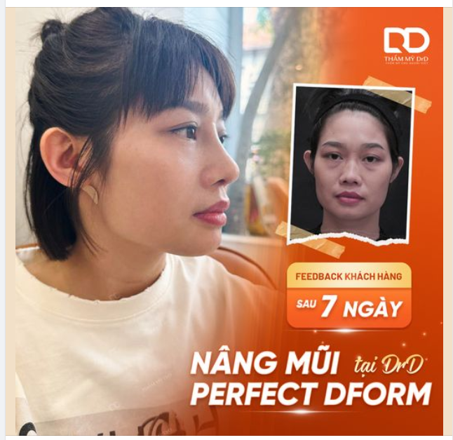 Feedback khách hàng sau 7 ngày nâng mũi Perfect Dform tại thẩm mỹ DrD