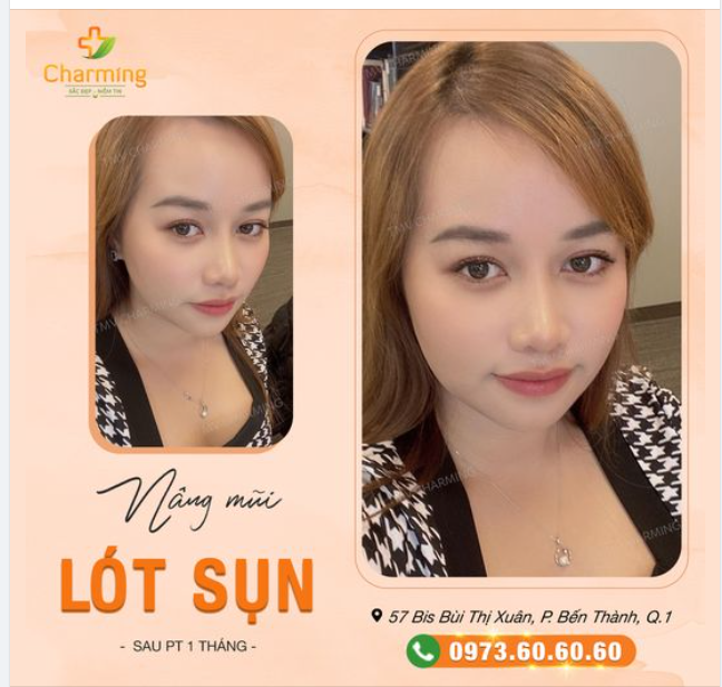 Mũi em lót sụn cao cao. Tự tin tỏa sáng làm bao người nhìn