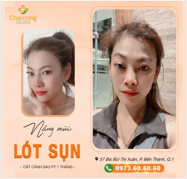 Mũi em lót sụn gọn gàng. Lại thêm cắt cánh làm chàng thích mê