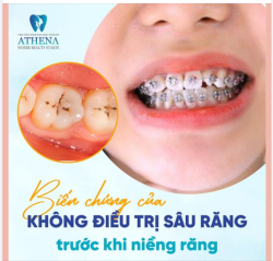 Biến chứng của không điều trị bệnh lý sâu răng trước khi niềng răng