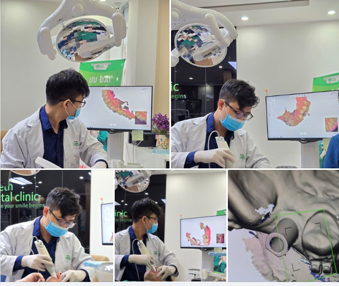 Công nghệ lấy dấu implant chính xác, chuẩn đến từng "mi li mét" cùng Bác sĩ Giang tại Nha khoa Yteeth.