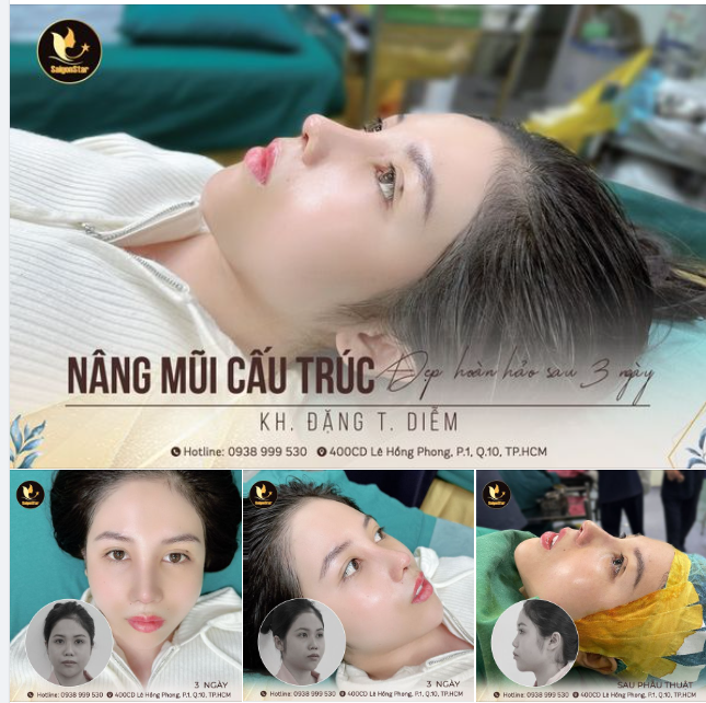 THÁO NẸP MŨI SAU 3 NGÀY - LỘ NGAY SIÊU PHẨM