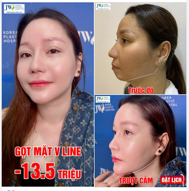 GỌT MẶT V LINE + TRƯỢT CẰM biến hóa Thiếu nữ 9X gương mặt ĐẸP MỌI GÓC CẠNH, xóa nỗi lo CẰM LẸM, HÀM TO