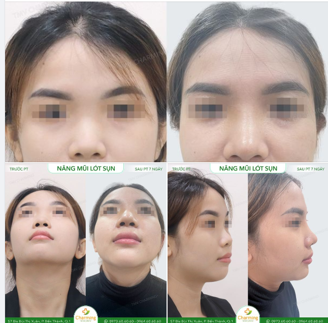 Sóng mũi thấp khiến cả gương mặt trông thiếu đi nét sắc sảo đã làm nàng khách rất tự ti.