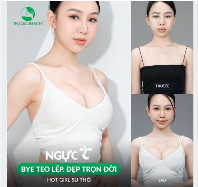 Sở hữu V1 căng mềm, tự nhiên sau 60P với Ngực TC