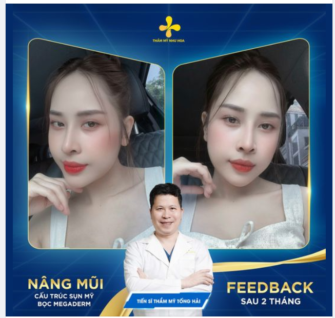 Niềm vui khi sửa mũi thành công.