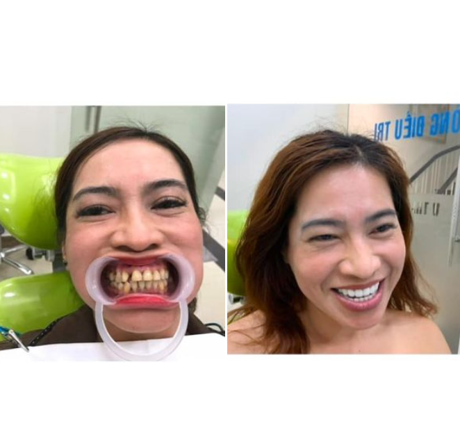 LÀM 3R TẶNG 1R